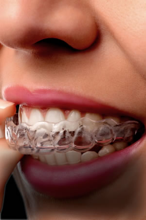 Durable Splints, Guards, and Aligners